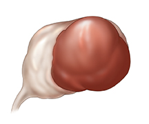 Endométriome.