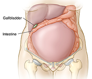 Outline of front view of pregnant woman's abdomen. Pelvis and thigh bones are visible. Pregnant uterus takes up much of abdomen, intestines are moved to side and top of uterus. Liver is in upper right of abdomen, with gallbladder protruding below it. Uterus is pressing on gallbladder.