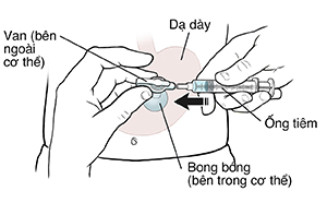 Hình chiếu trước bụng cho thấy ống thông dạ dày, bóng và bơm tiêm. Bàn tay đang nối ống tiêm với ống thông dạ dày.