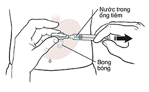 Hình chiếu trước bụng cho thấy ống thông dạ dày, bóng và bơm tiêm. Bàn tay đang giữ ống tiêm trong ống thông dạ dày, hút nước ra khỏi bóng.