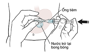 Hình chiếu trước bụng cho thấy ống thông dạ dày, bóng và bơm tiêm. Bàn tay đang giữ ống tiêm trong ống thông dạ dày, đẩy pít-tông để bơm nước vào bóng.
