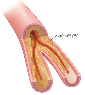 مقطع عرضي لشريان يُظهر تراكم اللويحات ومنع تدفق الدم.