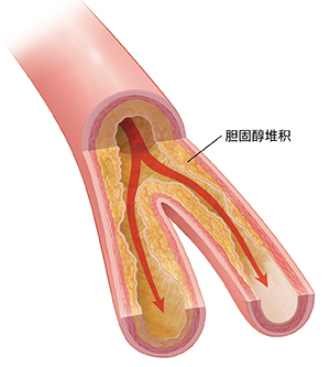 显示斑块积聚和血流受限的动脉的横截面。